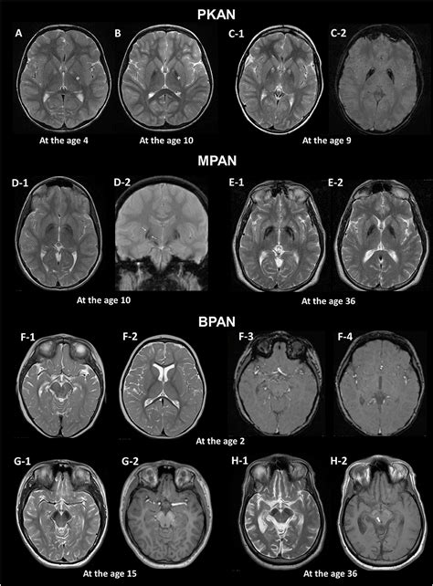 Normal Brain Mri With Contrast Images Radiologia