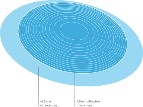 Image result for Refractive Multifocal IOL