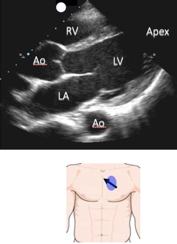 Image result for Parasternal Long Axis Ultrasound