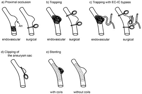 Afbeeldingsresultaten voor Vertebral Artery Dissecting Aneurysm