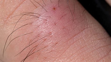 Afbeeldingsresultaten voor Carbuncle Symptoms