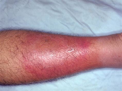 Image result for Tissue Death On the Leg