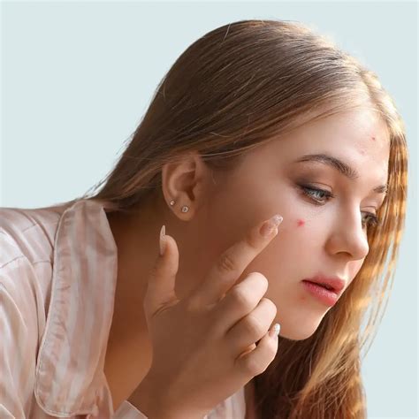 DIY Remove Sebaceous Cyst に対する画像結果