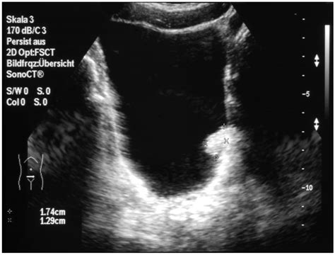 Toradh íomhá ar Pediatric Bladder