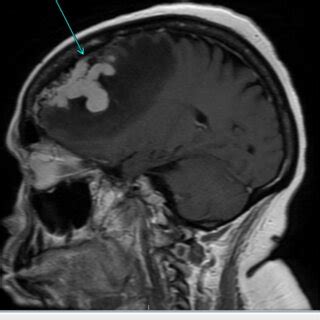 Afbeeldingsresultaten voor Frontal Cortex MRI Normal Side View