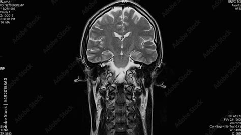 Magnetic resonance images of the brain (MRI brain), coronal plane axial ...