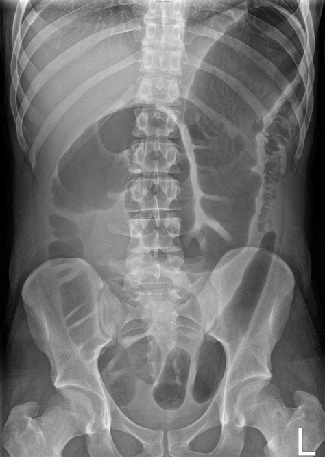Toxic Megacolon Next to Normal に対する画像結果