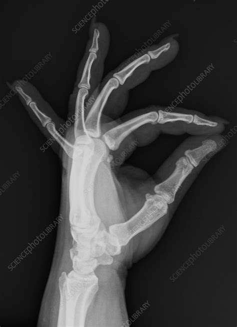 Normal Hand X Ray