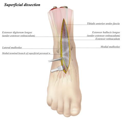 Ankle Posterolateral Approach に対する画像結果