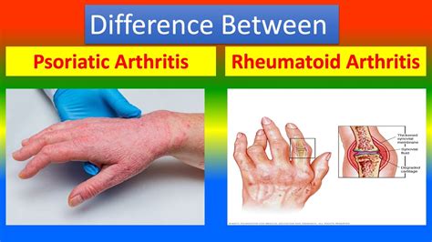 Image result for Inflammation Pathophysiology