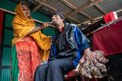 Tree Man Dies に対する画像結果