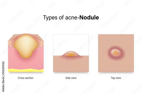 Inside Nodule Acne に対する画像結果