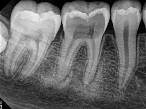 Image result for Broken Decayed Tooth