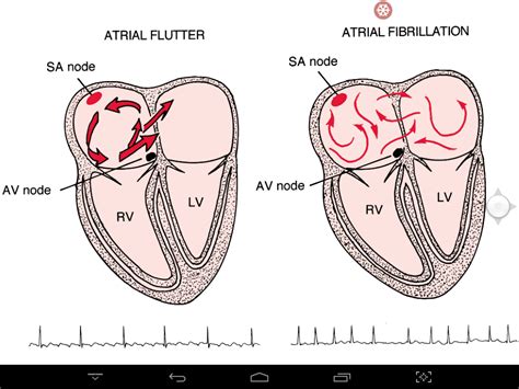 Image result for Typical Atrial Flutter