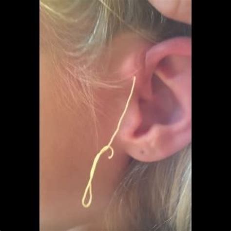 Gross Exploding Ear Pimple എന്നതിനുള്ള ഇമേജ് ഫലം