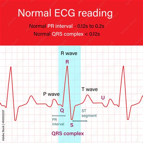 Image result for Normal ECG Intervals