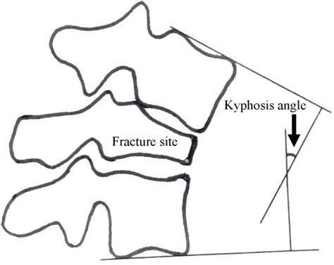 Afbeeldingsresultaten voor Angular Kyphosis TB Spine