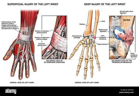 Ligament Damage in Hand に対する画像結果