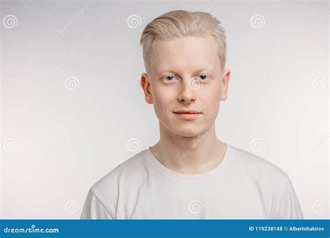 Light Blue Eyes Albinism に対する画像結果