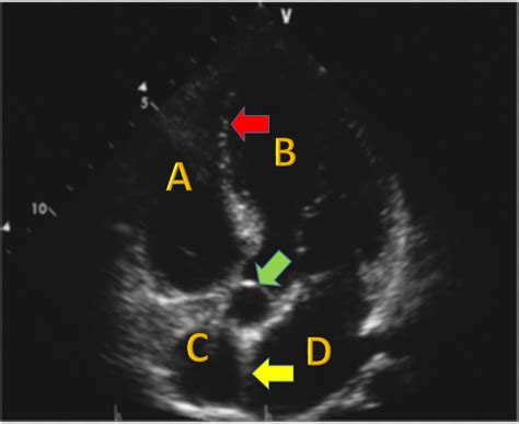 Apical 5 Chamber View に対する画像結果