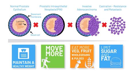 Prostate Cancer and Gangrene に対する画像結果