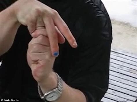 Image result for Eye Pops Out of Socket