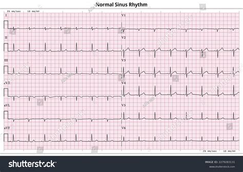 Image result for Normal EcG