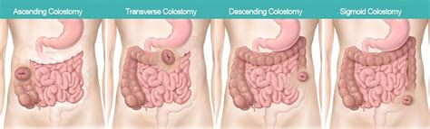 Image result for Types of Colostomy