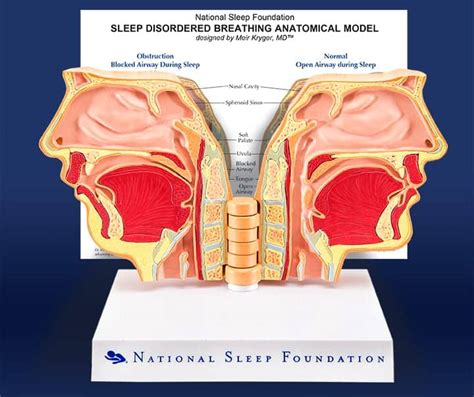 Sleep Apnea Diagram ପାଇଁ ପ୍ରତିଛବି ଫଳାଫଳ