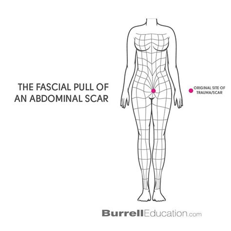 Image result for Muscle Scar Tissue Fascia