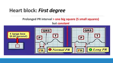 Image result for ECG Step by Step Guide