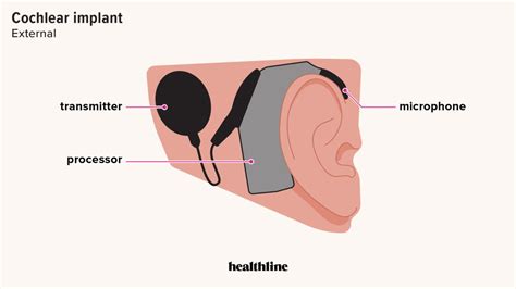 Image result for What Is Cochlear Implant