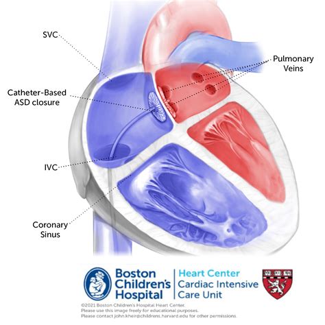 Toradh íomhá ar Atrial Septal Defect Classification