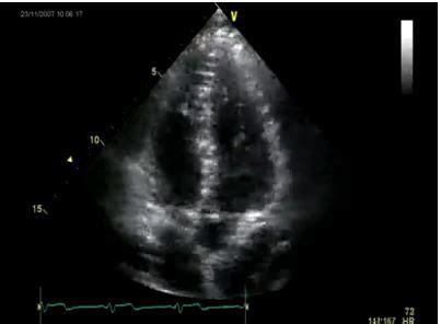 Apical 5 Chamber View に対する画像結果