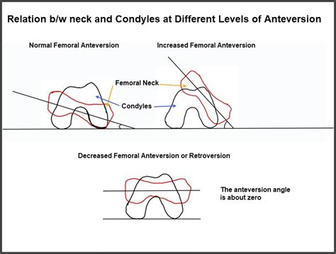 Toradh íomhá ar Femoral Anteversion vs Retroversion