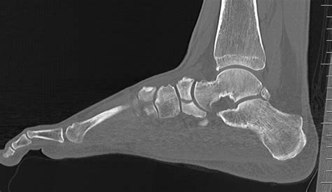 Afbeeldingsresultaten voor Navicular Foot Fracture Splint