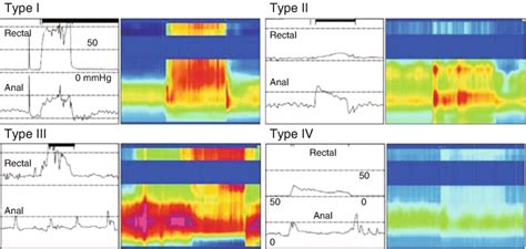 Image result for Conventional Manometry vs High Resolution Manometry