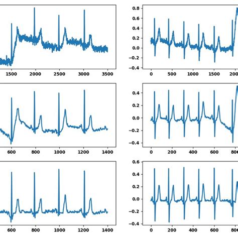 Hand Based ECG Signal に対する画像結果