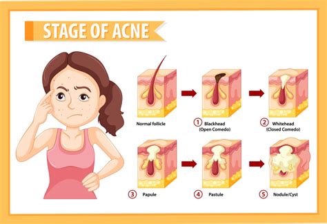Inside Nodule Acne に対する画像結果