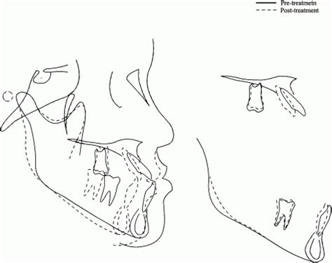 Image result for Maxillary Protraction