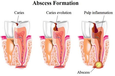 Image result for Abscess Tooth