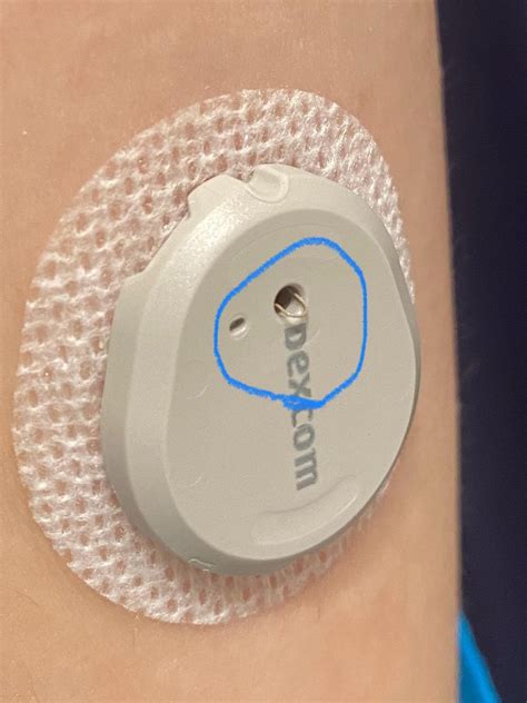 Toradh íomhá ar Dexcom One Sealed Sensor