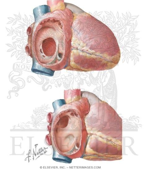 Image result for Ruis Atrium Septum Defect