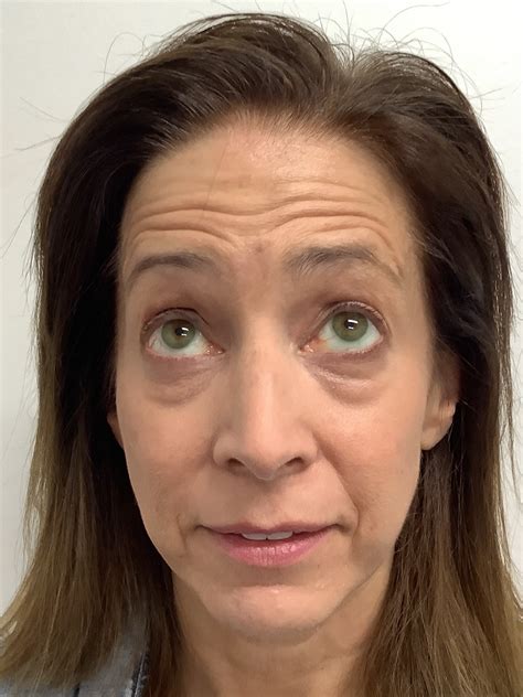 Image result for Botox Wrinkle Cream