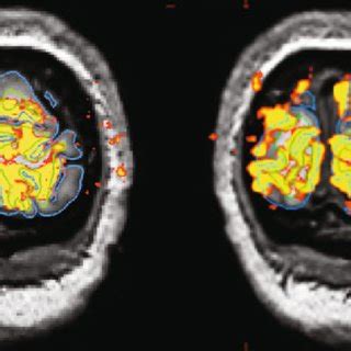Visual Cortex Activation Map Surface に対する画像結果