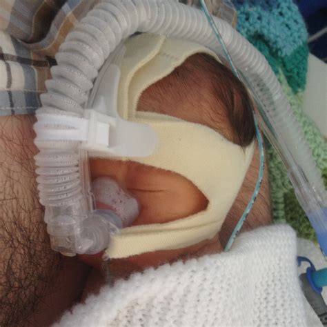 Image result for Newborn CPAP