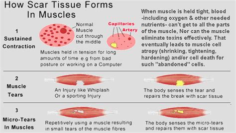 Image result for Muscle Scar Tissue Fascia