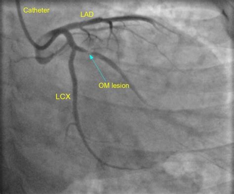 Image result for Angiographic Views