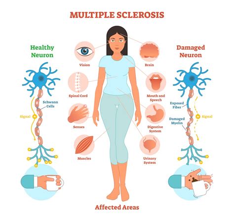 What causes multiple sclerosis? What we know, don’t know and suspect