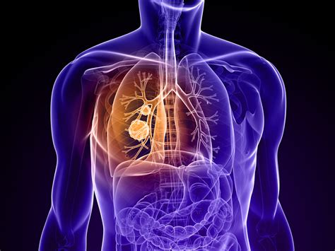 Lung Function Test NHS కోసం చిత్ర ఫలితం